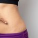 Understanding the Emotional Impact of Stretch Marks: Addressing Society’s Perception and Promoting Self-Acceptance
