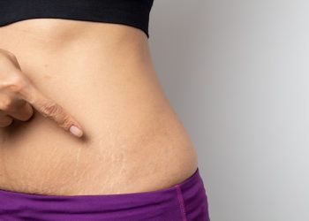 Exploring the Effectiveness of Shea Butter in Treating Stretch Marks: Fact or Fiction