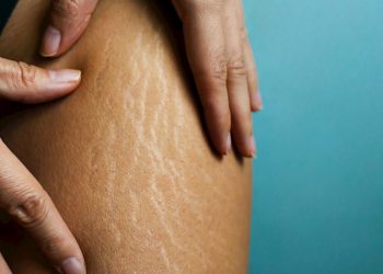 Understanding and Managing Stretch Marks: A Comprehensive Guide for Spray Tanning Enthusiasts