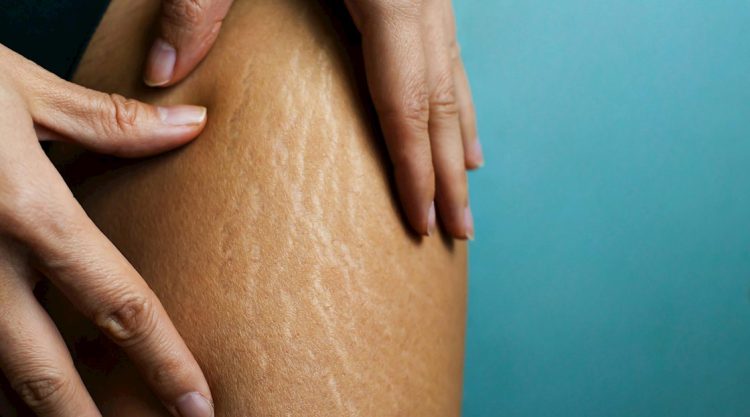Understanding and Managing Stretch Marks: A Comprehensive Guide for Spray Tanning Enthusiasts