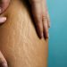 Understanding and Managing Stretch Marks: A Comprehensive Guide for Spray Tanning Enthusiasts