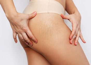 Revolutionary Inkless Removal Technique: Say Goodbye to Stretch Marks