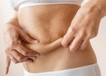 Revitalizing Skin with Plasma Pen: A Breakthrough Treatment for Stretch Marks