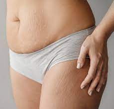 Exploring MCA Treatment: An Innovative Approach to Diminishing Stretch Marks