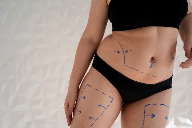 Rejuvenate Your Skin: The Power of Fractional Laser Treatment for Stretch Marks