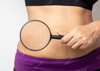 Basking in Glow: Understanding and Managing Stretch Marks in the Aftermath of a Spray Tan