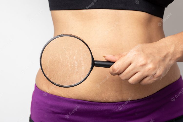 Basking in Glow: Understanding and Managing Stretch Marks in the Aftermath of a Spray Tan