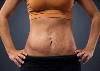 Rejuvenating Your Abdomen: Tummy Tuck as a Solution for Stretch Marks