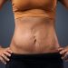 Rejuvenating Your Abdomen: Tummy Tuck as a Solution for Stretch Marks