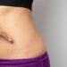 Stretch Imprints: Causes, Treatment, and Anticipation