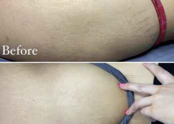 How to Remove Stretch Marks Permanently? Solutions for All Users