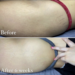 How to Remove Stretch Marks Permanently? Solutions for All Users