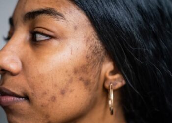 What Kind of Marks Are They? Types, Their Causes, and How to Handle Them