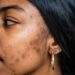 What Kind of Marks Are They? Types, Their Causes, and How to Handle Them