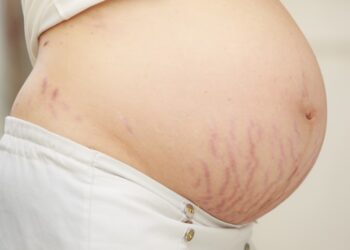 How to get rid of stretch marks