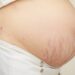 How to get rid of stretch marks