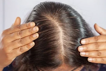 THE BALDNESS STARTING STAGE: HOW TO DETECT HAIR LOSS EARLY