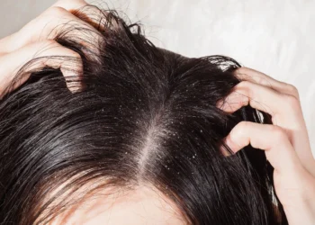 Frequently Asked Questions About the Causes of Dandruff: Understand the Most Common Reasons and Expert Answers